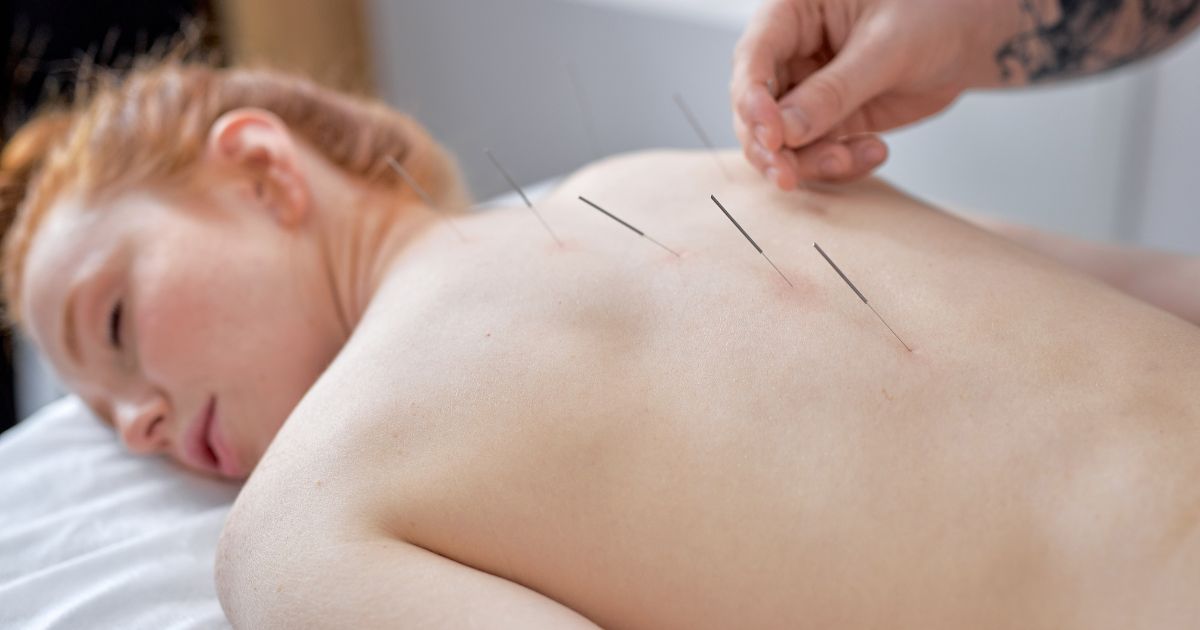 Woman Getting Acupuncture